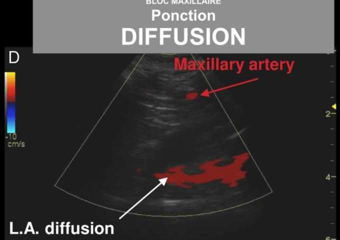 Bloc Maxillaire sous Echographie