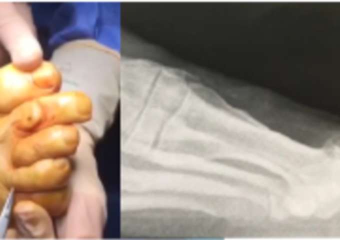 1er Rayon de l'Avant Pied