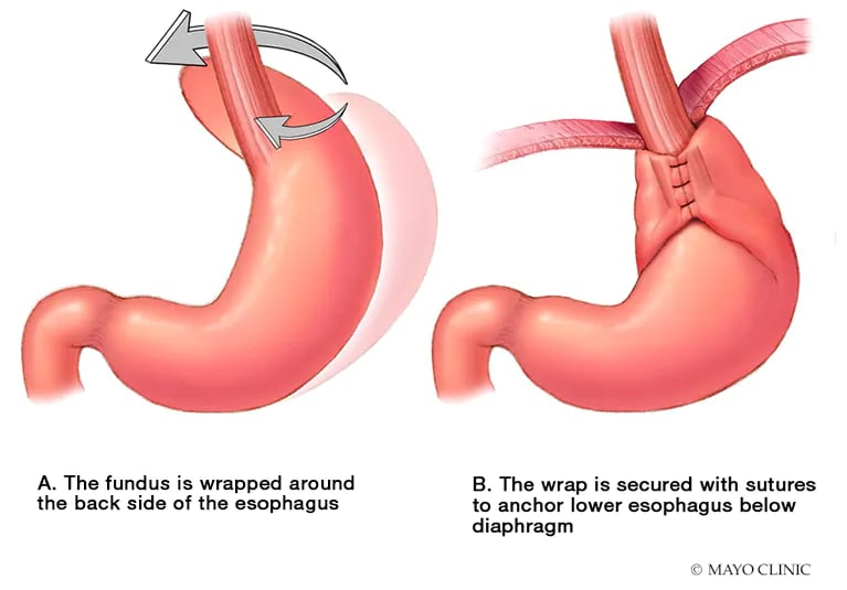 Partial Fundoplication