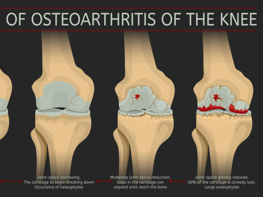 arthritis