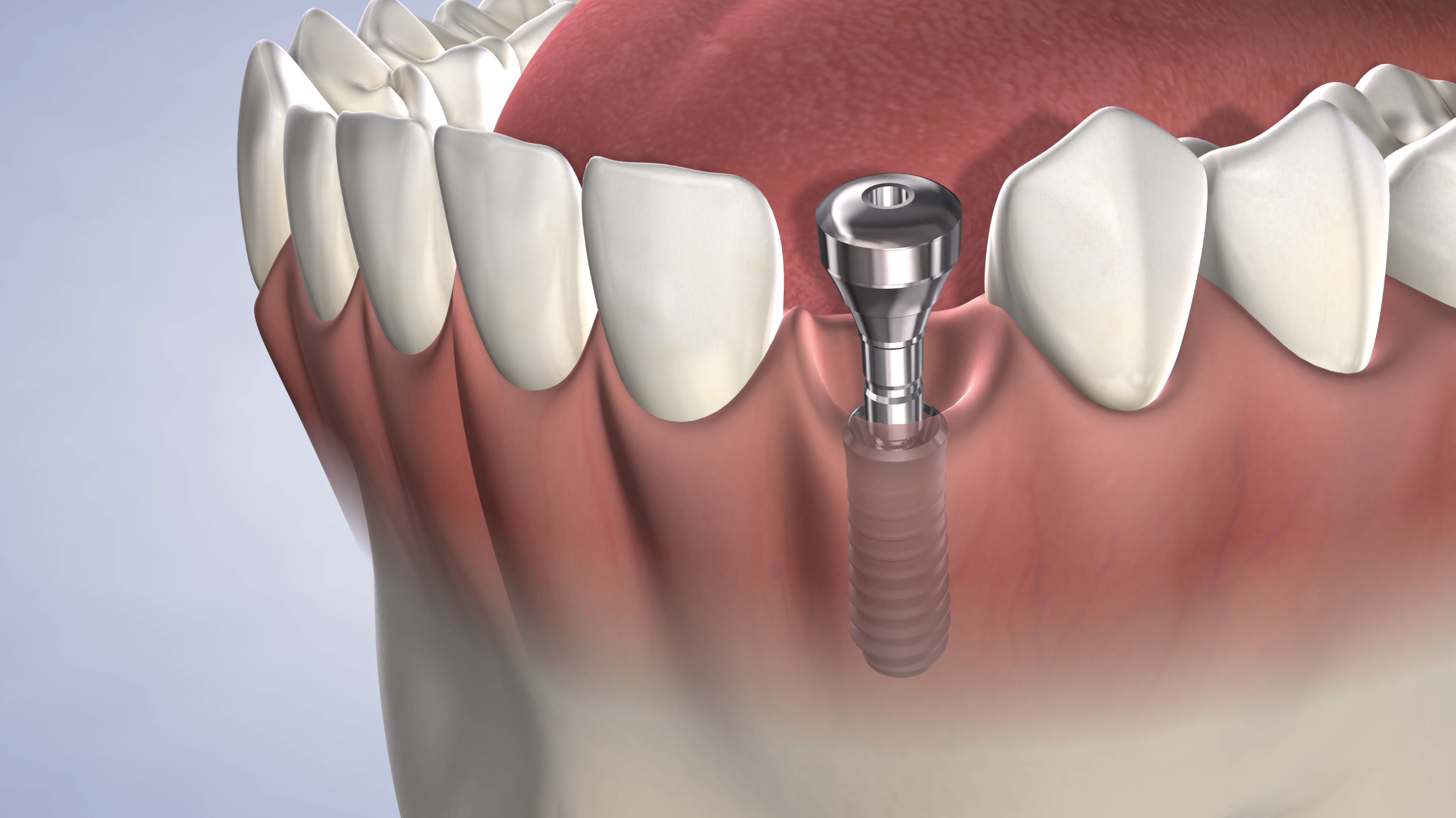 procedure-dental-implant