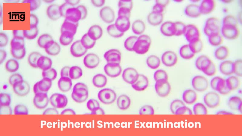 Peripheral Smear Examination