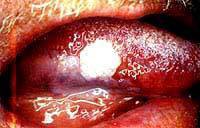 Lesão precursora de câncer – Leucoplasia Lesão precursora de câncer – Leucoplasia