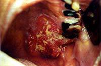 Lesão precursora de câncer – Eritroplasia Lesão precursora de câncer – Eritroplasia