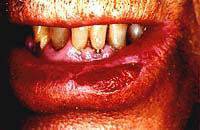Lesão Labial Lesão Labial