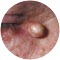 ArtificialCyst