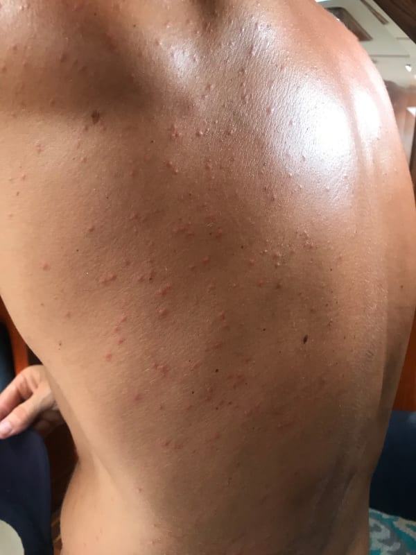 bug bites