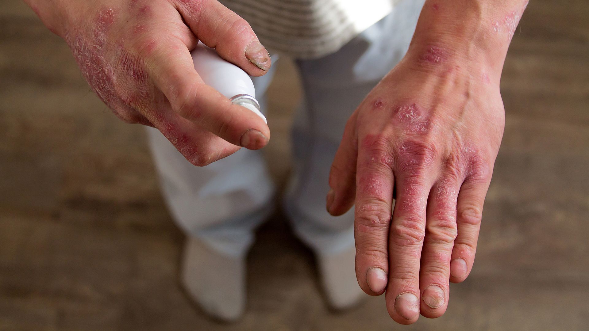 Is Psoriasis Mild, Moderate or Severe?