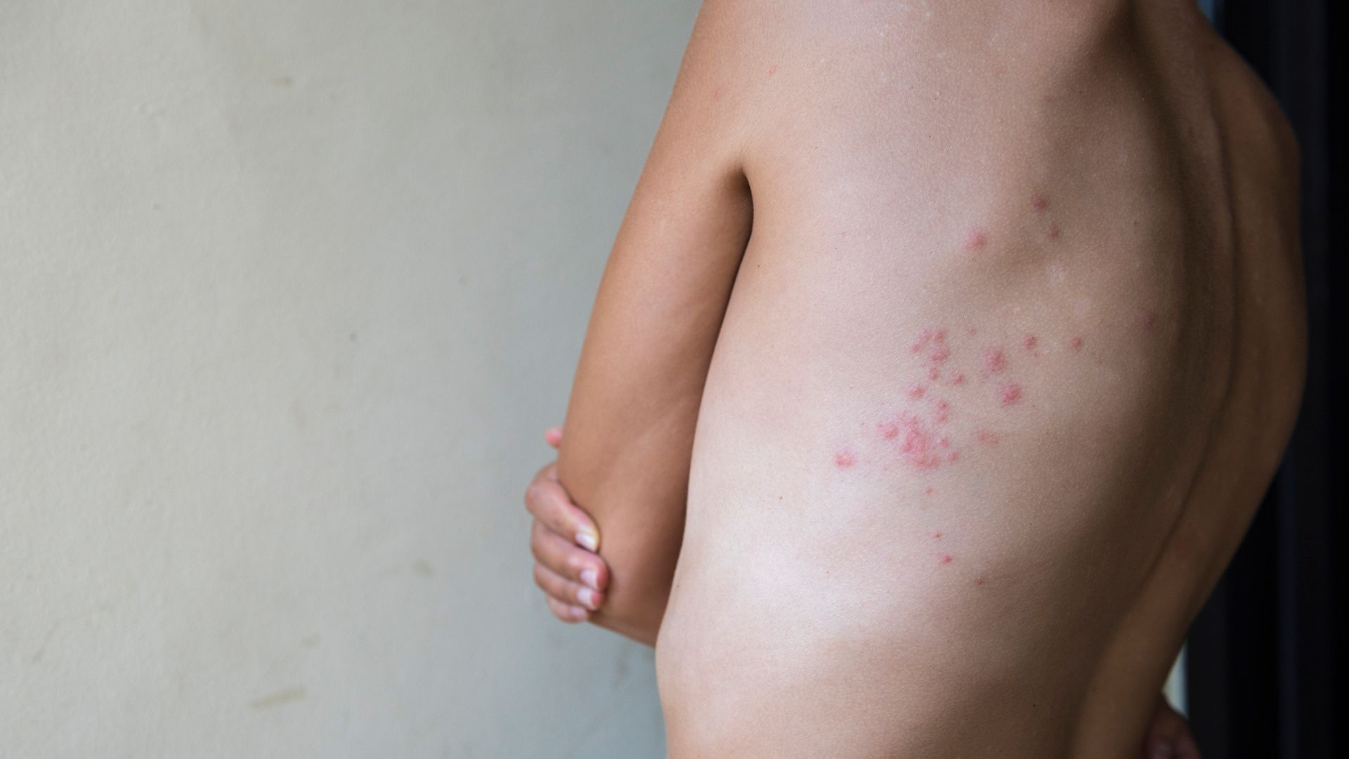 If You Had Chickenpox, You May Also Develop Shingles—Here's How