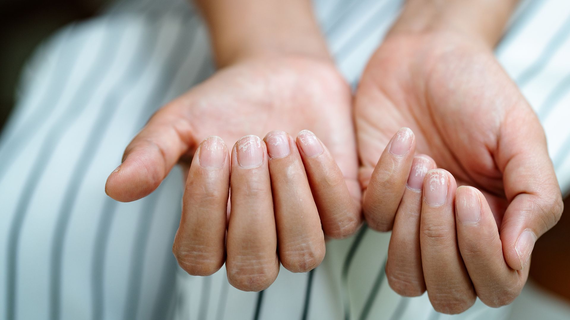 Healthy hand and foot care tips for psoriatic arthritis