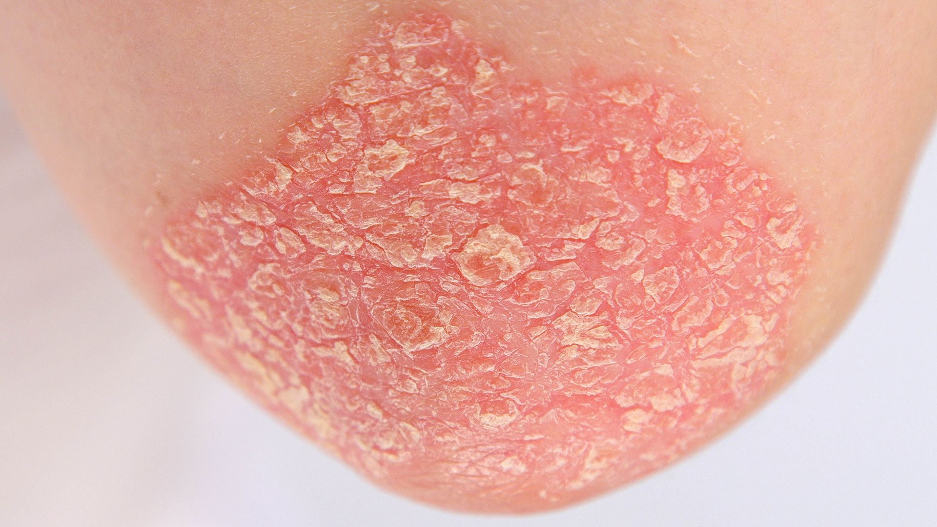 How to recognize different types of psoriasis