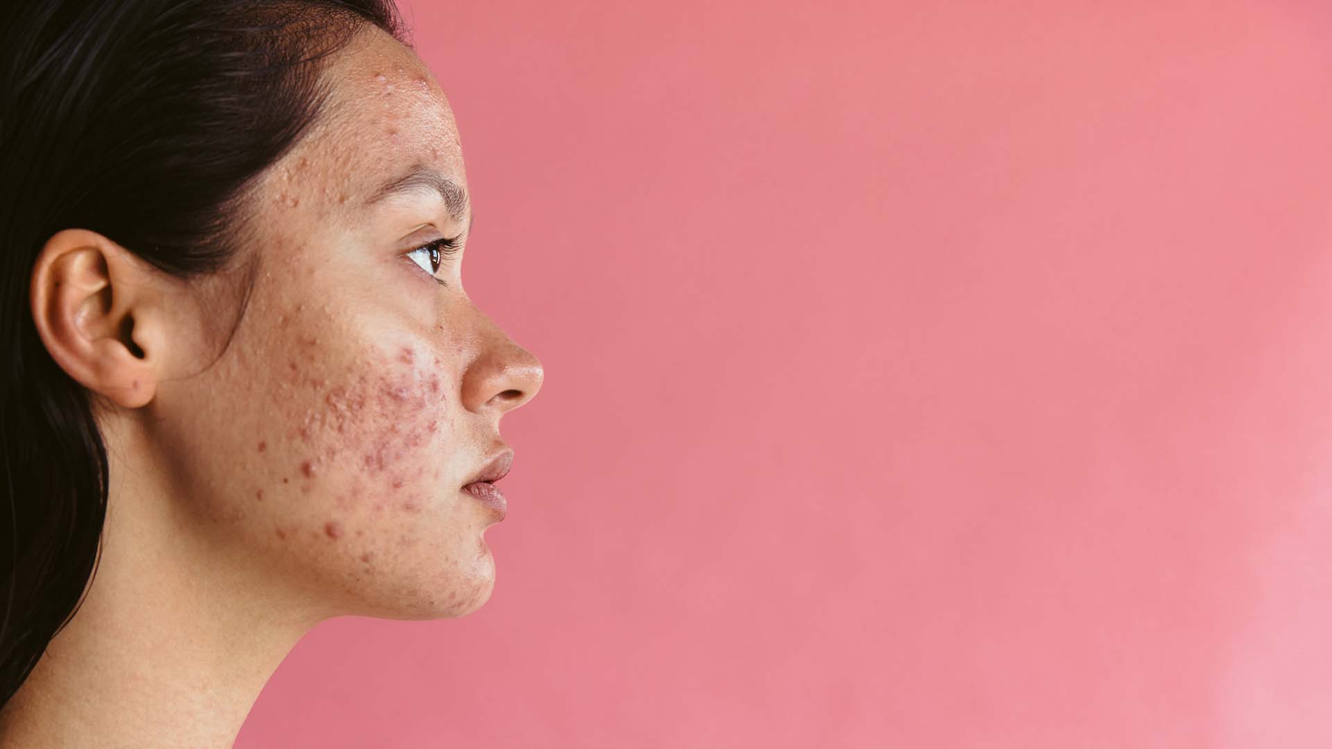 Understanding Types of Acne and Acne Severity