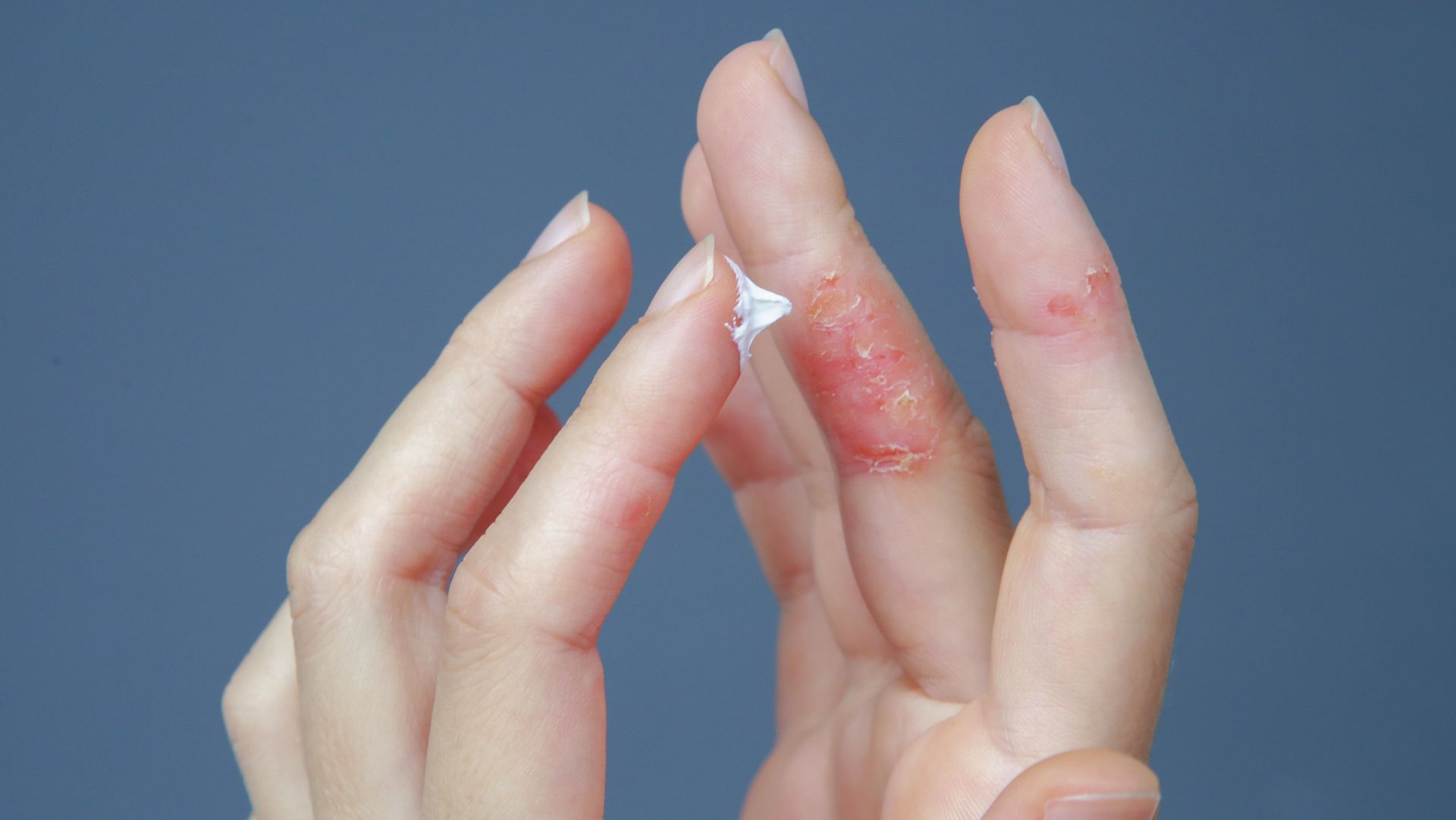 5 different ways to look at atopic dermatitis