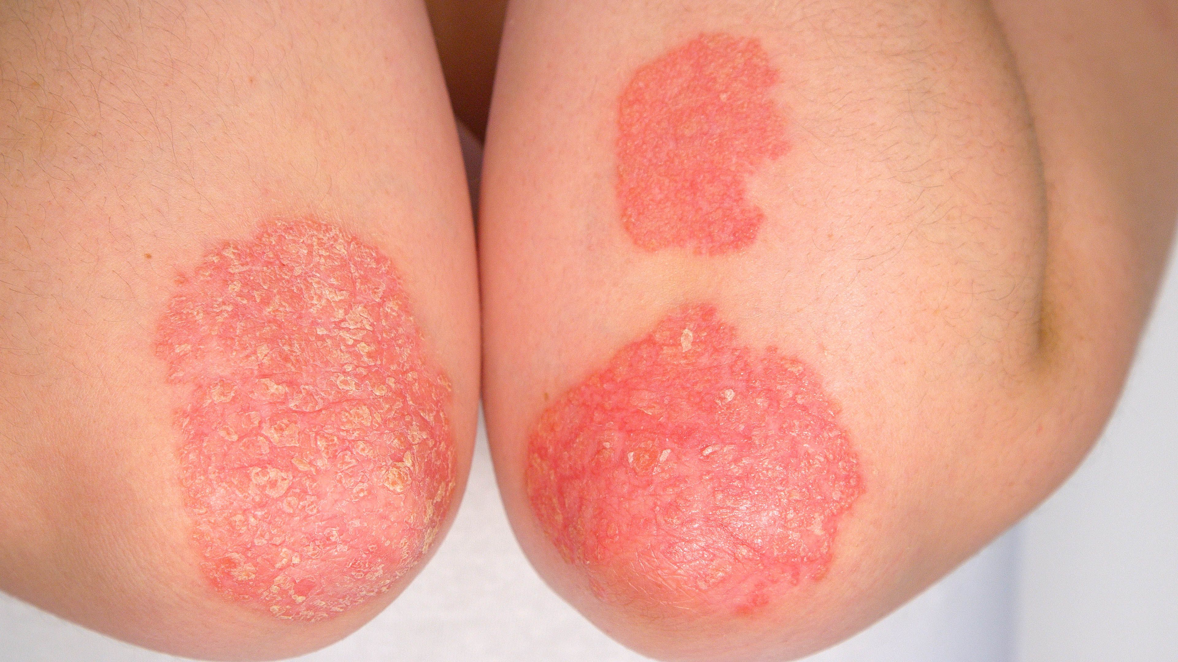 My psoriasis treatment isn’t working, what are my options?