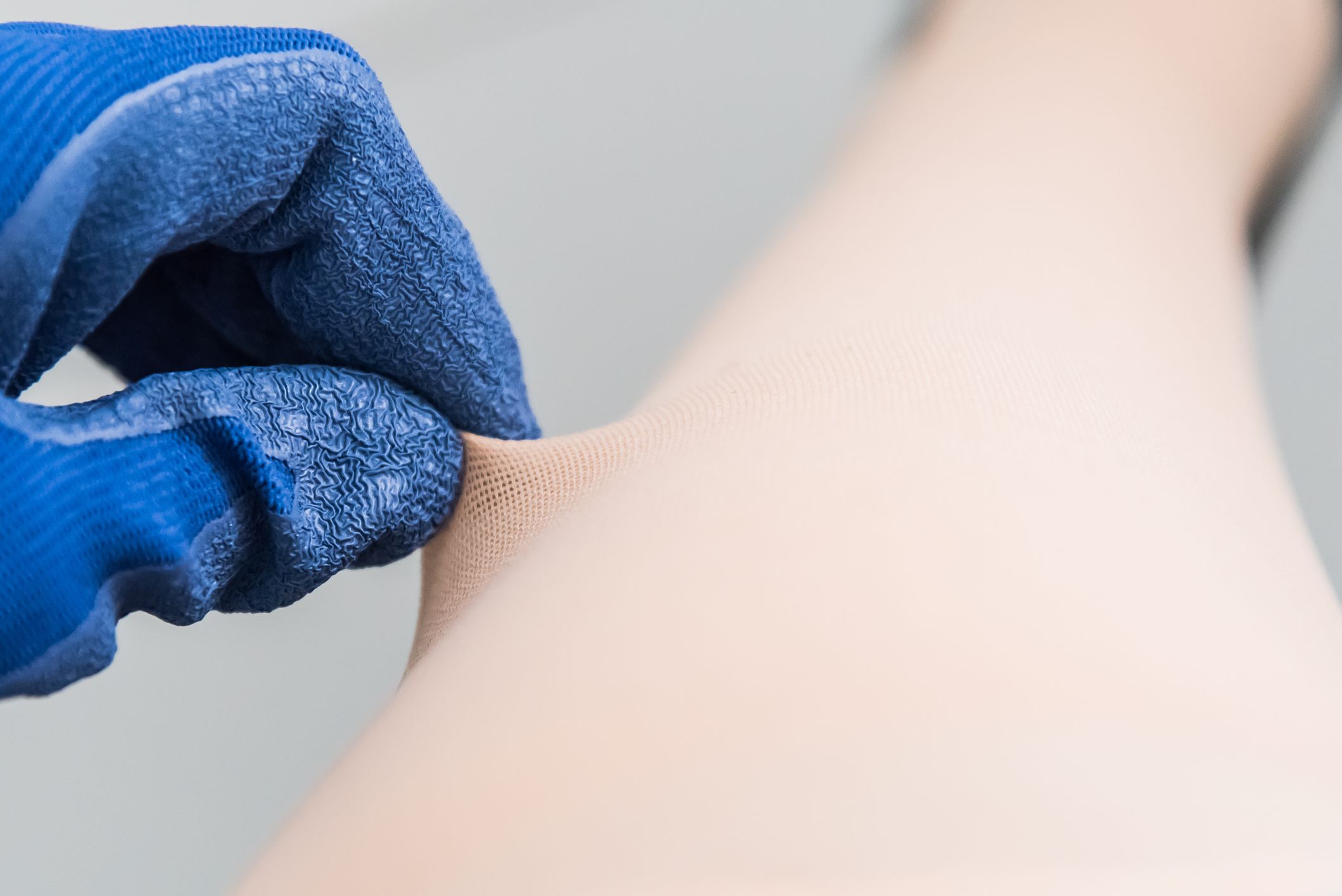 5 answers about Graves’ disease and thyroid dermopathy