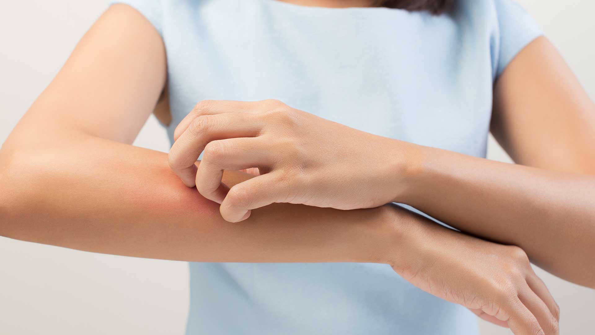 Eczema
