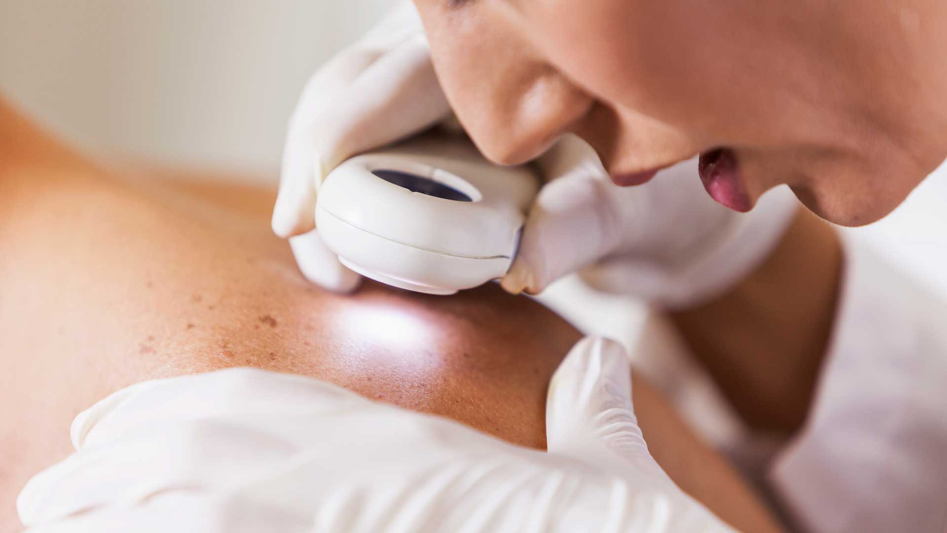 Skin Cancer