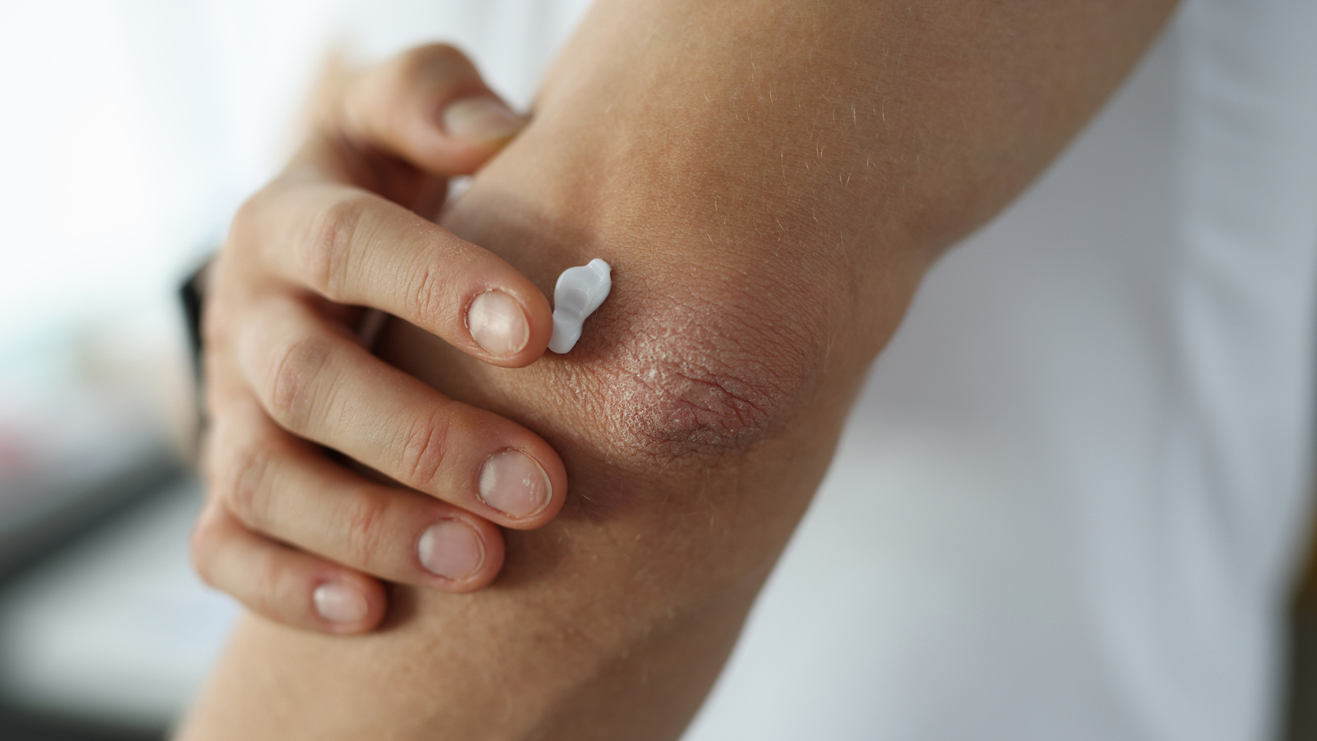 Psoriasis Treatment