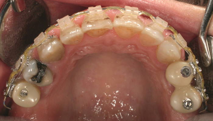 Publikation „Individuelle Verankerung auf konventionellen Implantaten zur orthodontischen Bewegung bei Erwachsenen“