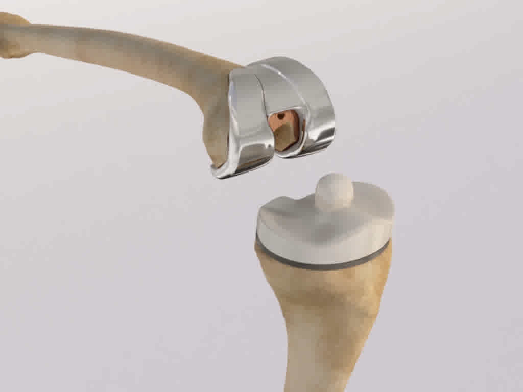 Knee replacement surgery