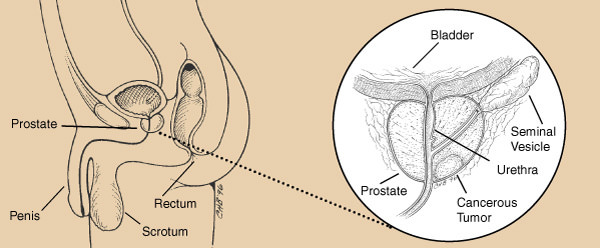 post.name What is Prostate Cancer?