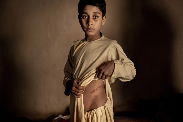 Asia, Stories. Unable to afford food for the family, the parents of Khalil Ahmad (15) decided to sell his kidney for US$3,500. The lack of jobs and the threat of starvation has led to a dramatic increase in the illegal organ trade. Herat, Afghanistan, 19 January 2022. © Mads Nissen, Politiken/Panos Pictures