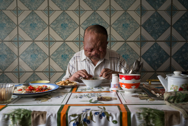 © Phil Hatcher-Moore. Berik Syzdykov (38) was born with birth defects after his pregnant mother was exposed to radiation from a nuclear test blast conducted by the Soviet Union in the Semipalatinsk Test Site in Kazakhstan. He is blind, and has had several operations to reduce the swelling in his face.