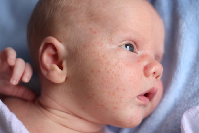 Coconut Oil Is The Best Remedy For Baby Acne Coconut Oil Is The Best Remedy For Baby Acne