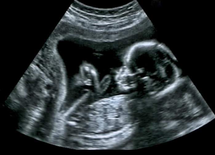 ultrasound.jpg Baby with Big Nose On Ultrasound