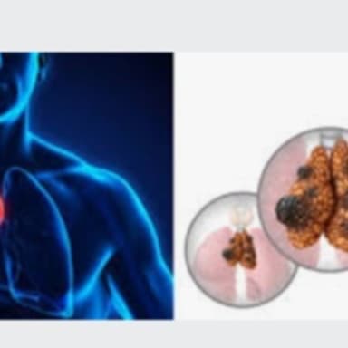 Cancer du thymus