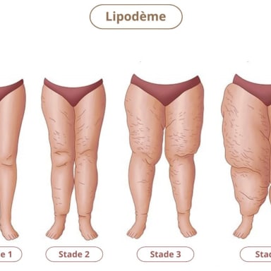 Mon combat contre le lipœdème