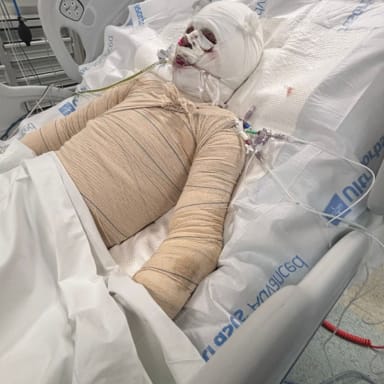 Soutien urgent pour Ilyes A., 19 ans, gravement brûlé à plus de 90 %
