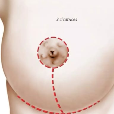 réduction mammaire