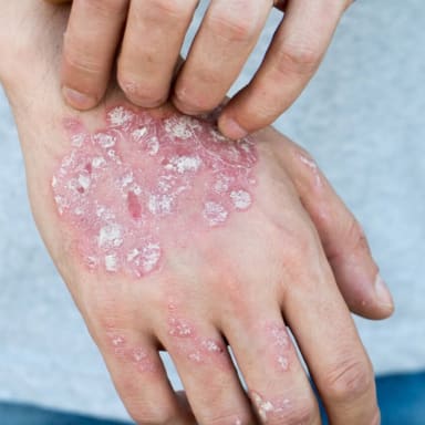 Psoriasis