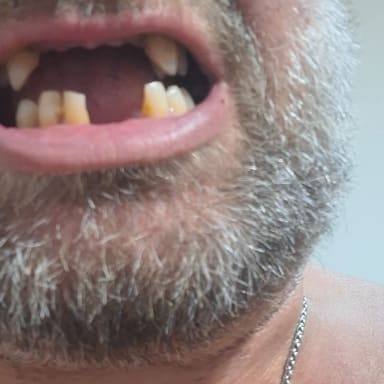Implant dentaire