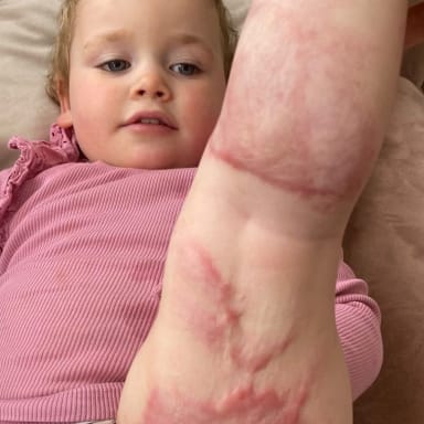 Aidons Frona, petite fille gravement brûlée, à recevoir les soins ❤️