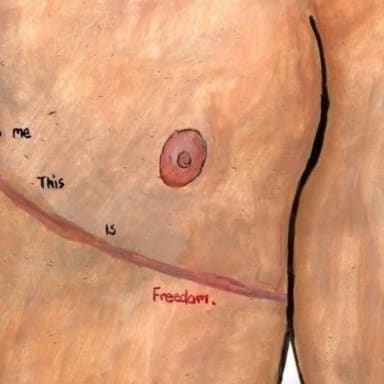 Torsoplastie FTM