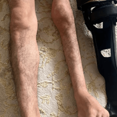 Une prothèse pour marcher à nouveau