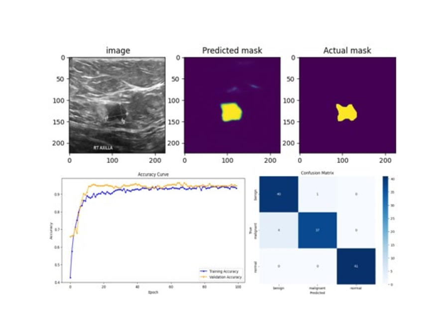 Breast ultrasound segmentation and hybrid classification workflow