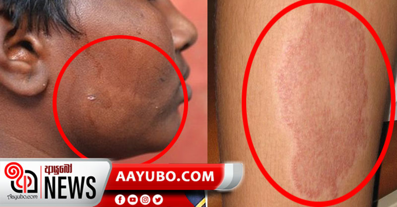 සමේ ලප ගැන දෙවරක් සිතන්න : ලාදුරු යළි හිස ඔසවයි