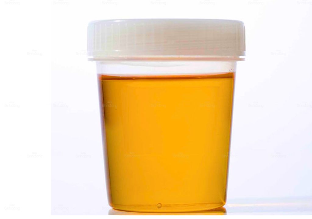 Nước tiểu màu cam là bị gì? Giải mã nguyên nhân và cách điều trị