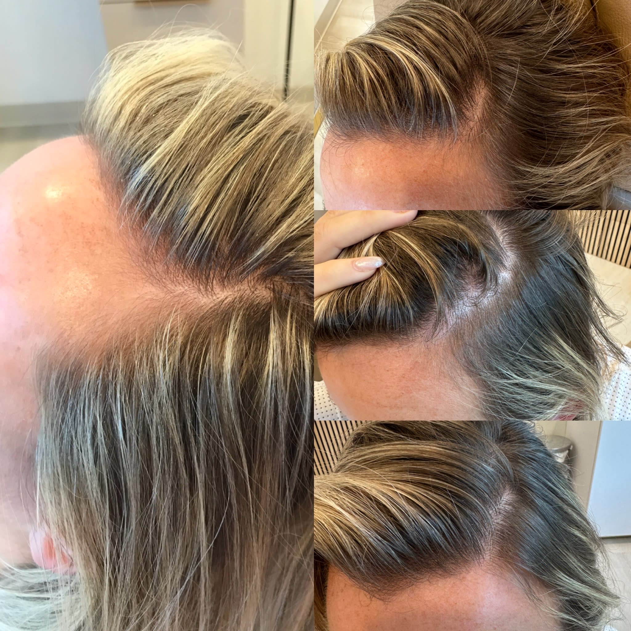 Hair Restoration