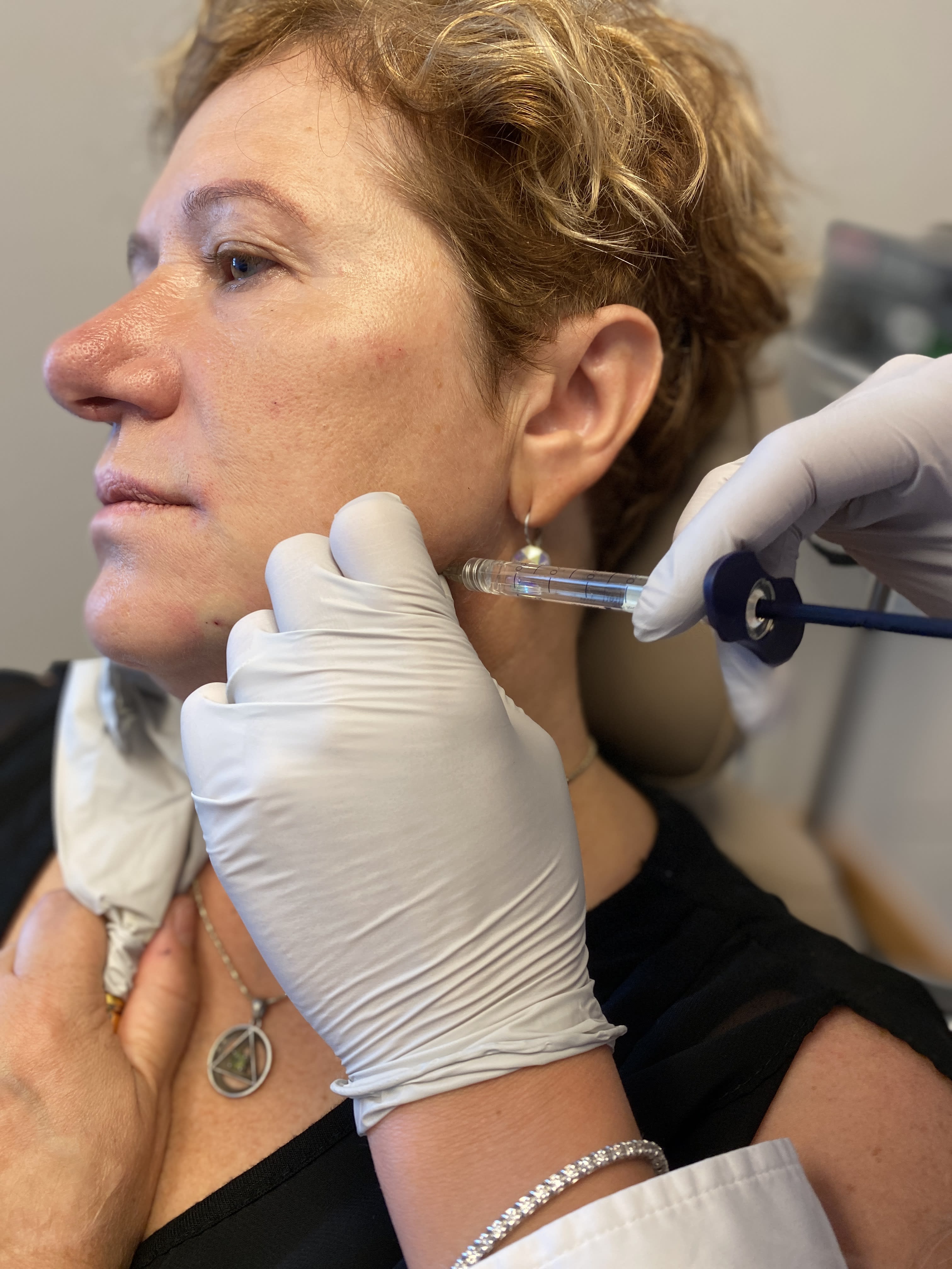 Microneedling
