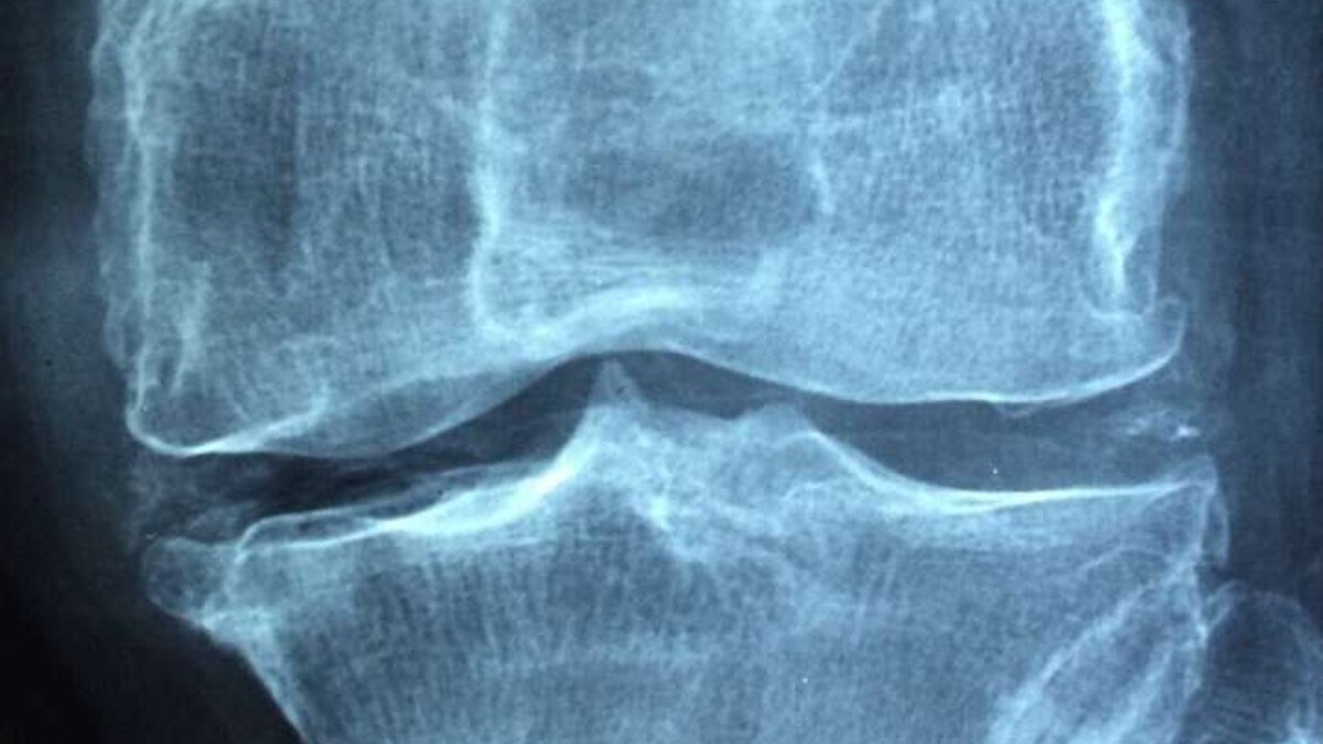 Scientists find new target for bone loss treatment - bone loss