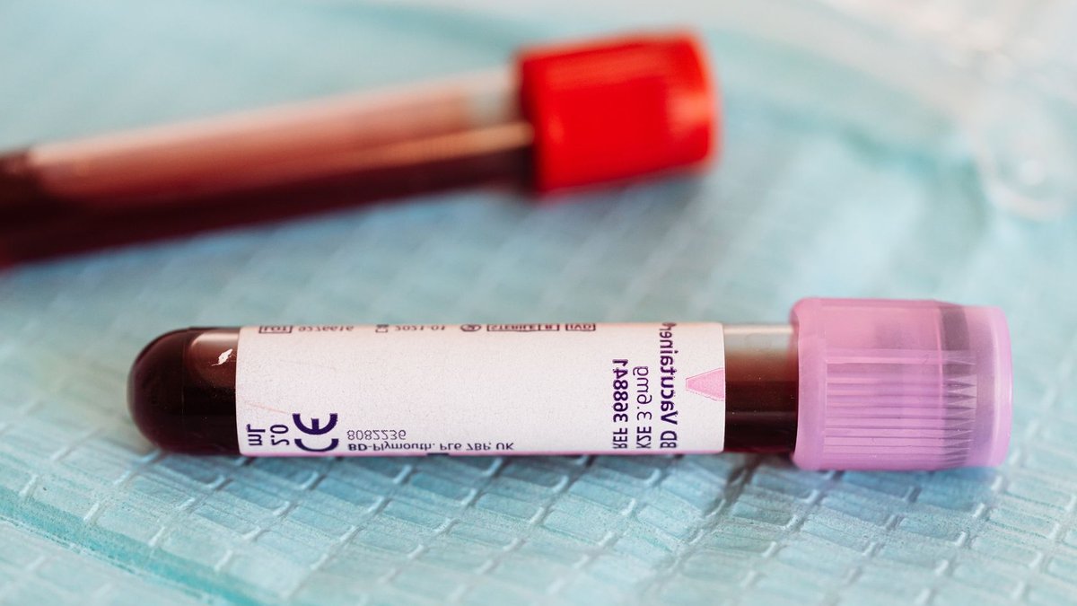 Patients with polycythemia vera continue experiencing symptoms From above closeup of glass full of vein blood vials with different colors lids placed on medical diaper.