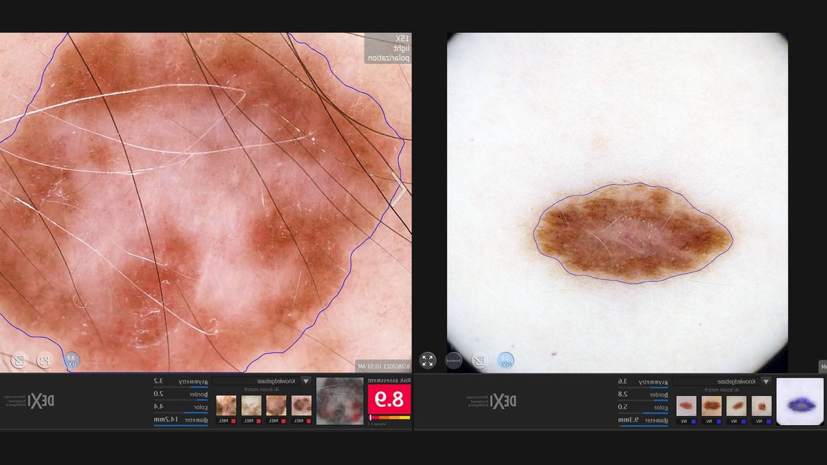 AI tool aids dermatologists in spotting skin cancer risks AI tool aids dermatologists in spotting skin cancer risks - ai dermatology tool