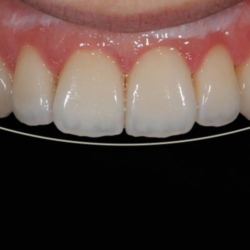 Veneers, Vorher Nachher Praxis für Rekonstruktive & Ästhetische Zahnmedizin