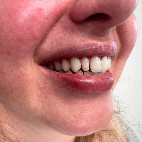 Lumineers / Non prep Veneers in Baar Praxis für Rekonstruktive & Ästhetische Zahnmedizin