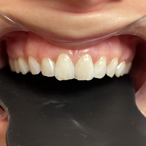 Veneers, Vorher Nachher Praxis für Rekonstruktive & Ästhetische Zahnmedizin