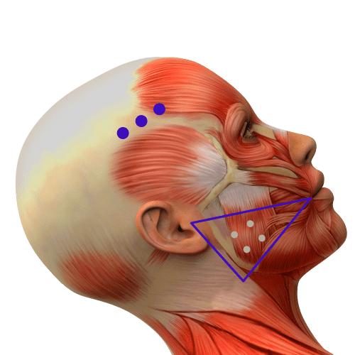 Bruxismus Therapie mit Botox